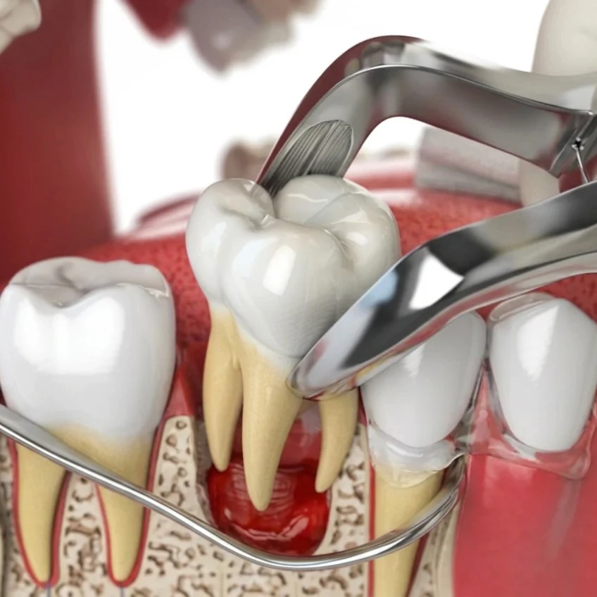 Extractions