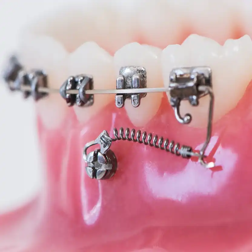 Chirurgie à visée orthodontique