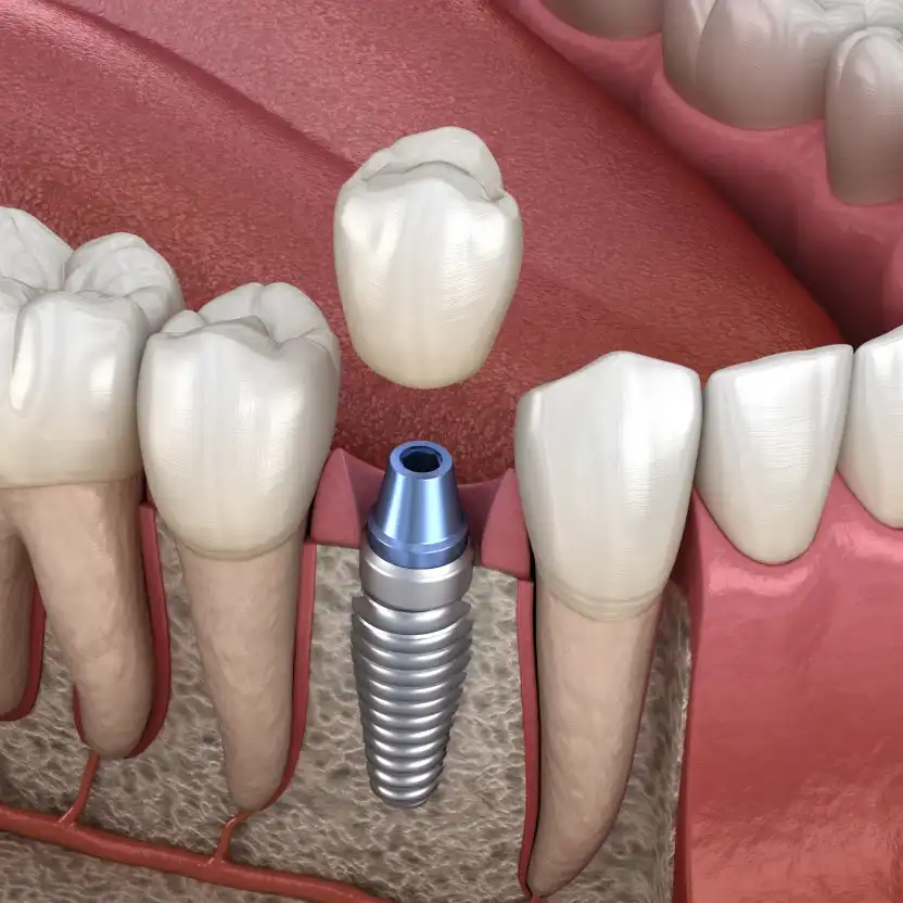 Implants dentaires