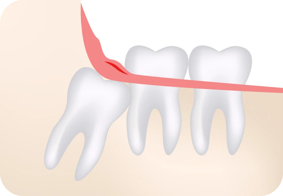 chirurgie-orale-dents-sagesse-cabinet MB 2