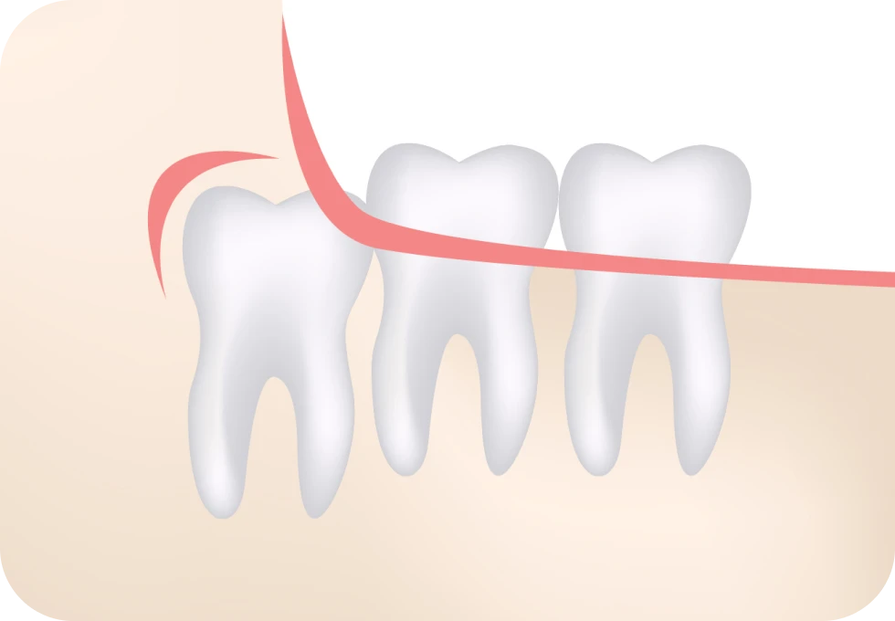 chirurgie-orale-dents-sagesse-cabinet MB
