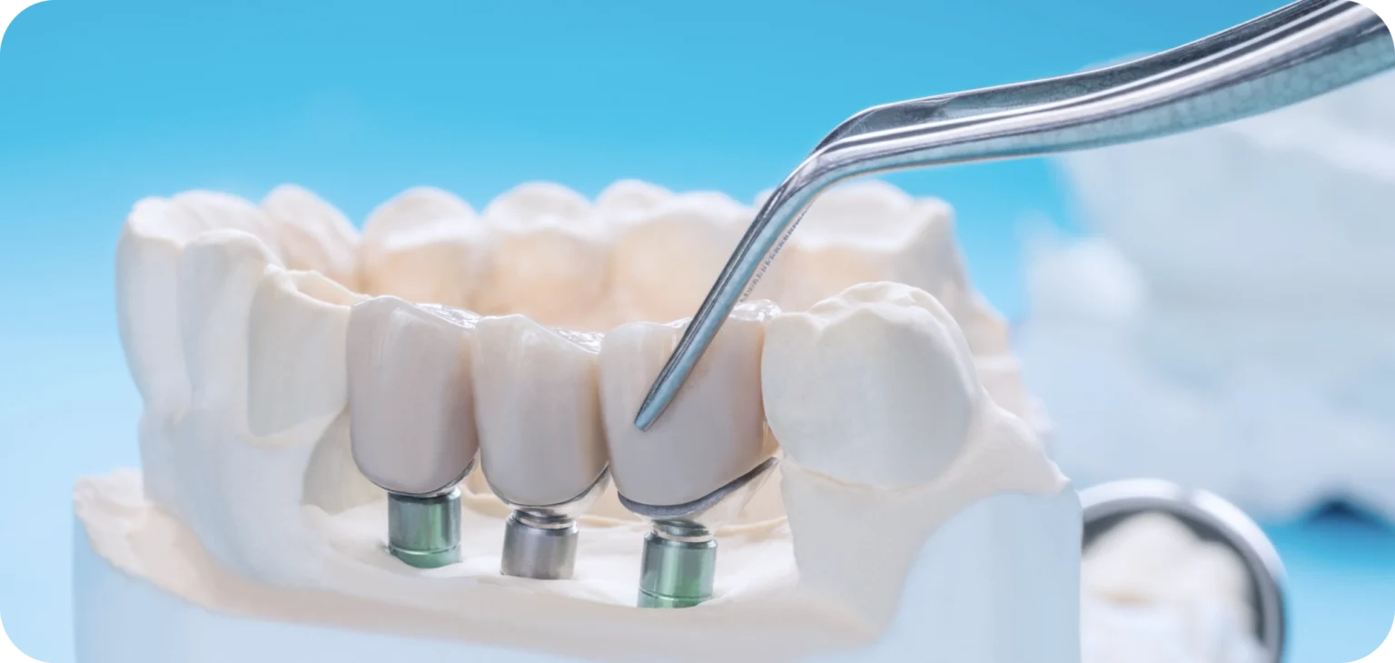 implant-dentaire-cabinet MB